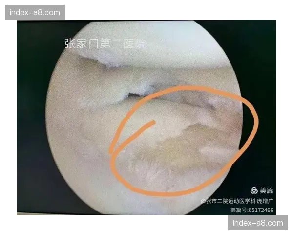 学术研究：《运动医学杂志》新论文探讨高节奏比赛与十字韧带损伤的相关性